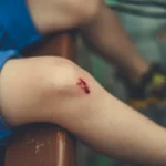 Elbow Surgery Recovery: What Tyson Fury's Former Opponent's Bruise Actually Means